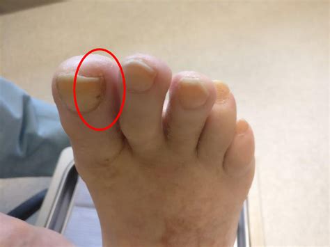 stubbed toe nail coming off